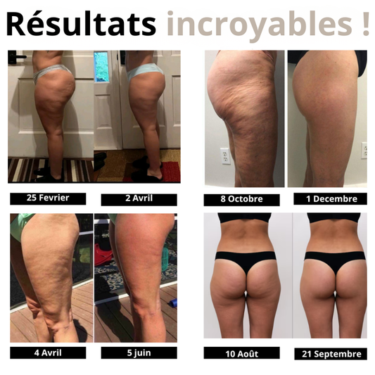 Drainage et cellulite : pourquoi votre legging classique vous ralentit ?